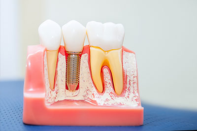 Emergency Dentist in Menifee